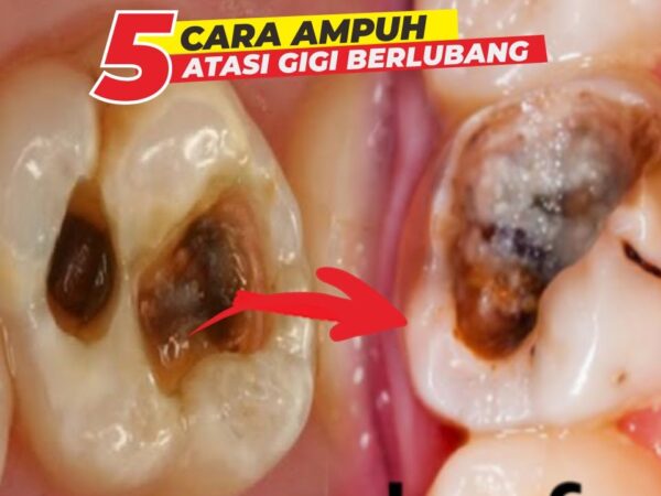 Mengatasi Sakit Gigi Berlubang: Panduan Lengkap untuk Meredakan Nyeri dan Perawatan Jangka Panjang