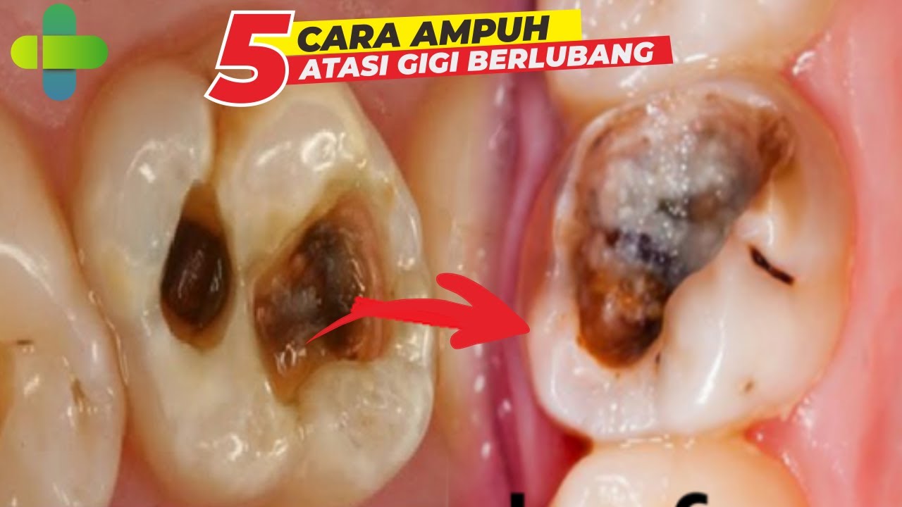 Mengatasi Sakit Gigi Berlubang: Panduan Lengkap untuk Meredakan Nyeri dan Perawatan Jangka Panjang