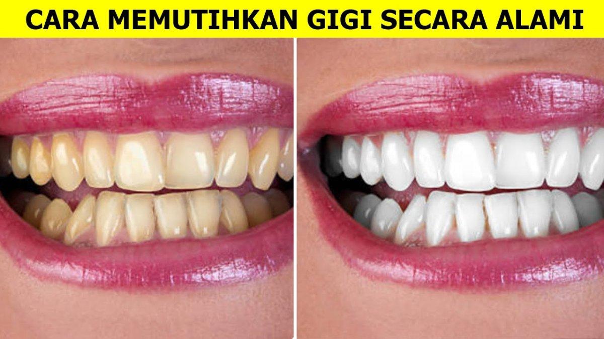 Rahasia Gigi Putih Alami: Metode Aman dan Efektif untuk Senyum Lebih Cerah