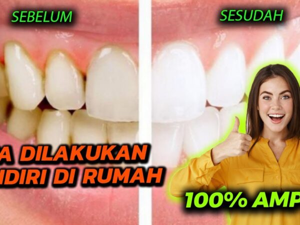 Senyum Bebas Karang Gigi: Panduan Mendalam Membersihkan dan Mencegahnya di Rumah